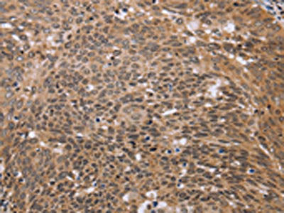 The image on the left is immunohistochemistry of paraffin-embedded Human cervical cancer tissue using CSB-PA170130(ERCC6L Antibody) at dilution 1/30, on the right is treated with fusion protein. (Original magnification: ×200)