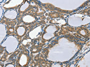 The image on the left is immunohistochemistry of paraffin-embedded Human thyroid cancer tissue using CSB-PA170230(SCD Antibody) at dilution 1/20, on the right is treated with synthetic peptide. (Original magnification: ×200)