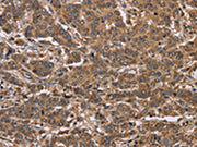 The image on the left is immunohistochemistry of paraffin-embedded Human liver cancer tissue using CSB-PA170264(FABP6 Antibody) at dilution 1/30, on the right is treated with fusion protein. (Original magnification: ×200)