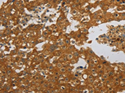 The image on the left is immunohistochemistry of paraffin-embedded Human breast cancer tissue using CSB-PA170330(NBN Antibody) at dilution 1/30, on the right is treated with synthetic peptide. (Original magnification: ×200)