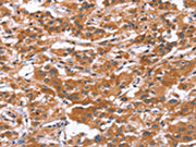 The image on the left is immunohistochemistry of paraffin-embedded Human thyroid cancer tissue using CSB-PA170354(GLMN Antibody) at dilution 1/30, on the right is treated with synthetic peptide. (Original magnification: ×200)