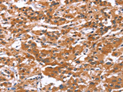 The image on the left is immunohistochemistry of paraffin-embedded Human thyroid cancer tissue using CSB-PA170354(GLMN Antibody) at dilution 1/30, on the right is treated with synthetic peptide. (Original magnification: ×200)