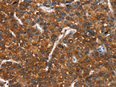 The image on the left is immunohistochemistry of paraffin-embedded Human liver cancer tissue using CSB-PA170398(CTBP1 Antibody) at dilution 1/40, on the right is treated with synthetic peptide. (Original magnification: ×200)