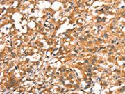 The image on the left is immunohistochemistry of paraffin-embedded Human thyroid cancer tissue using CSB-PA170450(DAP Antibody) at dilution 1/15, on the right is treated with synthetic peptide. (Original magnification: ×200)