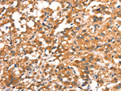 The image on the left is immunohistochemistry of paraffin-embedded Human thyroid cancer tissue using CSB-PA170450(DAP Antibody) at dilution 1/15, on the right is treated with synthetic peptide. (Original magnification: ×200)