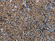 The image on the left is immunohistochemistry of paraffin-embedded Human thyroid cancer tissue using CSB-PA170597(GYS1 Antibody) at dilution 1/40, on the right is treated with fusion protein. (Original magnification: ×200)