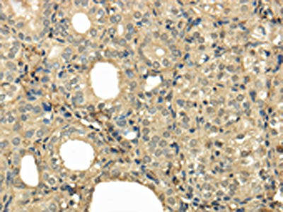 The image on the left is immunohistochemistry of paraffin-embedded Human thyroid cancer tissue using CSB-PA170670(UBE2B Antibody) at dilution 1/30, on the right is treated with fusion protein. (Original magnification: ×200)