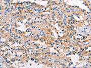 The image on the left is immunohistochemistry of paraffin-embedded Human thyroid cancer tissue using CSB-PA170873(TDGF1 Antibody) at dilution 1/15, on the right is treated with synthetic peptide. (Original magnification: ×200)