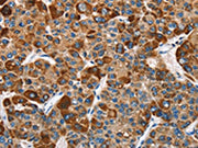 The image on the left is immunohistochemistry of paraffin-embedded Human liver cancer tissue using CSB-PA171015(SLAMF8 Antibody) at dilution 1/40, on the right is treated with fusion protein. (Original magnification: ×200)