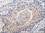 The image is immunohistochemistry of paraffin-embedded Human esophagus cancer tissue using CSB-PA171022(RAB22A Antibody) at dilution 1/100. (Original magnification: ×200)