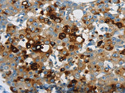 The image on the left is immunohistochemistry of paraffin-embedded Human breast cancer tissue using CSB-PA171092(LCN2 Antibody) at dilution 1/60, on the right is treated with synthetic peptide. (Original magnification: ×200)