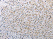 The image on the left is immunohistochemistry of paraffin-embedded Human liver cancer tissue using CSB-PA171204(LY75 Antibody) at dilution 1/25, on the right is treated with synthetic peptide. (Original magnification: ×200)