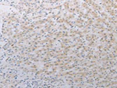 The image on the left is immunohistochemistry of paraffin-embedded Human liver cancer tissue using CSB-PA171204(LY75 Antibody) at dilution 1/25, on the right is treated with synthetic peptide. (Original magnification: ×200)