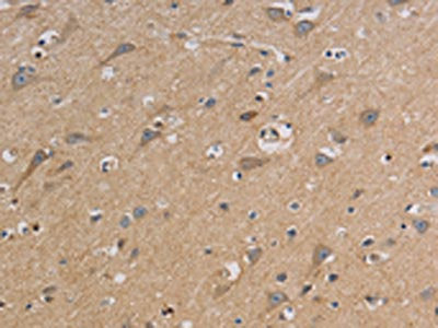 The image on the left is immunohistochemistry of paraffin-embedded Human brain tissue using CSB-PA171419(CCR2 Antibody) at dilution 1/20, on the right is treated with synthetic peptide. (Original magnification: ×200)