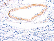 The image on the left is immunohistochemistry of paraffin-embedded Human breast cancer tissue using CSB-PA171540(TPM1 Antibody) at dilution 1/80, on the right is treated with fusion protein. (Original magnification: ×200)