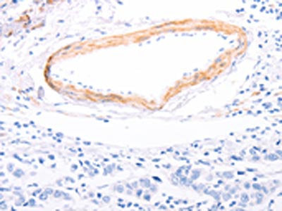 The image on the left is immunohistochemistry of paraffin-embedded Human breast cancer tissue using CSB-PA171540(TPM1 Antibody) at dilution 1/80, on the right is treated with fusion protein. (Original magnification: ×200)
