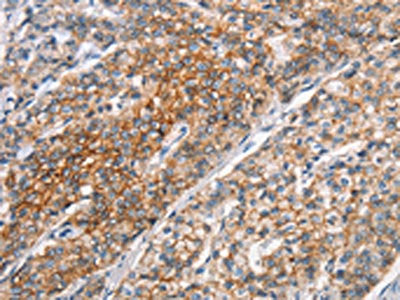 The image on the left is immunohistochemistry of paraffin-embedded Human prostate cancer tissue using CSB-PA171908(ALCAM Antibody) at dilution 1/25, on the right is treated with synthetic peptide. (Original magnification: ×200)