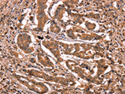 The image on the left is immunohistochemistry of paraffin-embedded Human breast cancer tissue using CSB-PA171912(BCL6 Antibody) at dilution 1/15, on the right is treated with synthetic peptide. (Original magnification: ×200)