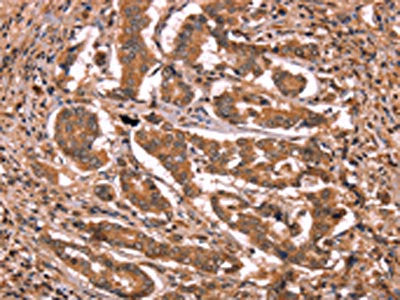 The image on the left is immunohistochemistry of paraffin-embedded Human breast cancer tissue using CSB-PA171912(BCL6 Antibody) at dilution 1/15, on the right is treated with synthetic peptide. (Original magnification: ×200)
