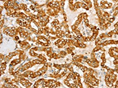 The image on the left is immunohistochemistry of paraffin-embedded Human thyroid cancer tissue using CSB-PA171916(PTPN22 Antibody) at dilution 1/20, on the right is treated with fusion protein. (Original magnification: ×200)