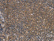 The image on the left is immunohistochemistry of paraffin-embedded Human Lymphoma tissue using CSB-PA172042(TNFRSF8 Antibody) at dilution 1/50, on the right is treated with synthetic peptide. (Original magnification: ×200)
