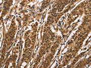 The image on the left is immunohistochemistry of paraffin-embedded Human gastic cancer tissue using CSB-PA172172(BAI1 Antibody) at dilution 1/40, on the right is treated with synthetic peptide. (Original magnification: ×200)