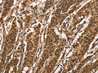 The image on the left is immunohistochemistry of paraffin-embedded Human gastic cancer tissue using CSB-PA172172(BAI1 Antibody) at dilution 1/40, on the right is treated with synthetic peptide. (Original magnification: ×200)