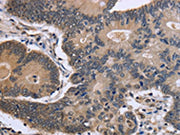 The image is immunohistochemistry of paraffin-embedded Human colon cancer tissue using CSB-PA172178(FSTL1 Antibody) at dilution 1/40. (Original magnification: ×200)