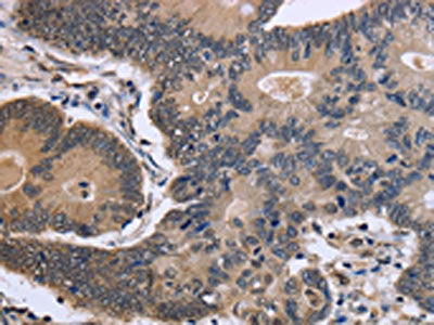 The image is immunohistochemistry of paraffin-embedded Human colon cancer tissue using CSB-PA172178(FSTL1 Antibody) at dilution 1/40. (Original magnification: ×200)