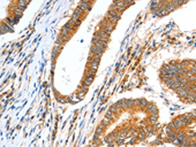 The image on the left is immunohistochemistry of paraffin-embedded Human colon cancer tissue using CSB-PA172235(CCNF Antibody) at dilution 1/30, on the right is treated with fusion protein. (Original magnification: ×200)