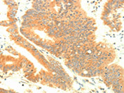 The image on the left is immunohistochemistry of paraffin-embedded Human colon cancer tissue using CSB-PA172305(TRAF3IP2 Antibody) at dilution 1/30, on the right is treated with fusion protein. (Original magnification: ×200)