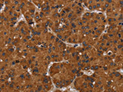 The image on the left is immunohistochemistry of paraffin-embedded Human liver cancer tissue using CSB-PA172361(NPHS2 Antibody) at dilution 1/40, on the right is treated with synthetic peptide. (Original magnification: X200)