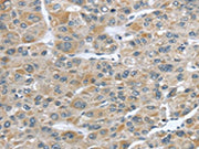 The image on the left is immunohistochemistry of paraffin-embedded Human liver cancer tissue using CSB-PA172691(CFAP45 Antibody) at dilution 1/25, on the right is treated with synthetic peptide. (Original magnification: ×200)