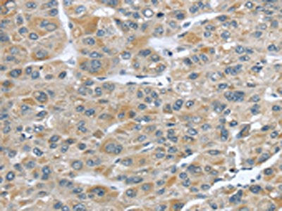 The image on the left is immunohistochemistry of paraffin-embedded Human liver cancer tissue using CSB-PA172691(CFAP45 Antibody) at dilution 1/25, on the right is treated with synthetic peptide. (Original magnification: ×200)