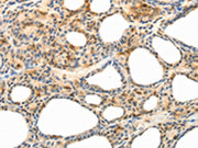 The image on the left is immunohistochemistry of paraffin-embedded Human thyroid cancer tissue using CSB-PA172806(CCR8 Antibody) at dilution 1/40, on the right is treated with synthetic peptide. (Original magnification: ×200)