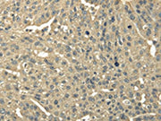 The image on the left is immunohistochemistry of paraffin-embedded Human breast cancer tissue using CSB-PA172809(TRIB2 Antibody) at dilution 1/30, on the right is treated with fusion protein. (Original magnification: ×200)