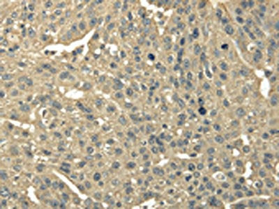 The image on the left is immunohistochemistry of paraffin-embedded Human breast cancer tissue using CSB-PA172809(TRIB2 Antibody) at dilution 1/30, on the right is treated with fusion protein. (Original magnification: ×200)