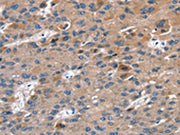 The image on the left is immunohistochemistry of paraffin-embedded Human liver cancer tissue using CSB-PA172973(RAB9A Antibody) at dilution 1/20, on the right is treated with fusion protein. (Original magnification: ×200)