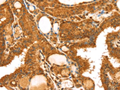 The image on the left is immunohistochemistry of paraffin-embedded Human thyroid cancer tissue using CSB-PA172995(TRIM25 Antibody) at dilution 1/40, on the right is treated with synthetic peptide. (Original magnification: ×200)