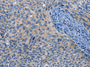 The image on the left is immunohistochemistry of paraffin-embedded Human cervical cancer tissue using CSB-PA173019(MAP2K1 Antibody) at dilution 1/25, on the right is treated with fusion protein. (Original magnification: ×200)