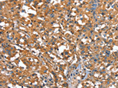 The image on the left is immunohistochemistry of paraffin-embedded Human thyroid cancer tissue using CSB-PA173074(CAPZA1 Antibody) at dilution 1/25, on the right is treated with synthetic peptide. (Original magnification: ×200)
