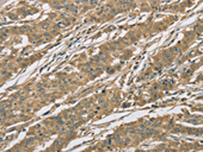 The image on the left is immunohistochemistry of paraffin-embedded Human gastic cancer tissue using CSB-PA173108(EIF3F Antibody) at dilution 1/25, on the right is treated with fusion protein. (Original magnification: ×200)