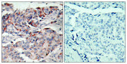 Immunohistochemical analysis of paraffin-embedded human breast carcinoma tissue, using JAK2 (phospho-Tyr221) antibody.