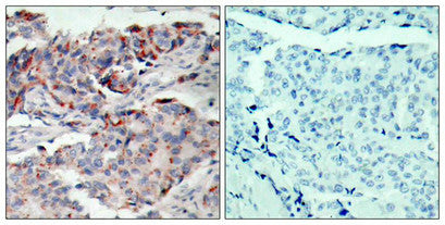 Immunohistochemical analysis of paraffin-embedded human breast carcinoma tissue, using JAK2 (phospho-Tyr221) antibody.