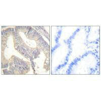 Immunohistochemical analysis of paraffin-embedded human colon carcinoma tissue using Gastrin antibody.