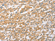 The image on the left is immunohistochemistry of paraffin-embedded Human thyroid cancer tissue using CSB-PA173231(EPS15L1 Antibody) at dilution 1/20, on the right is treated with fusion protein. (Original magnification: ×200)