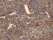 The image on the left is immunohistochemistry of paraffin-embedded Human liver cancer tissue using CSB-PA173238(ITGB1 Antibody) at dilution 1/50, on the right is treated with fusion protein. (Original magnification: ×200)