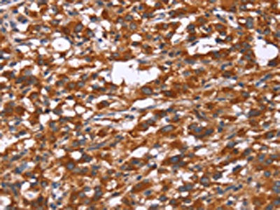 The image on the left is immunohistochemistry of paraffin-embedded Human thyroid cancer tissue using CSB-PA173468(GPHN Antibody) at dilution 1/30, on the right is treated with synthetic peptide. (Original magnification: ×200)