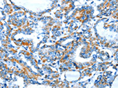 The image on the left is immunohistochemistry of paraffin-embedded Human thyroid cancer tissue using CSB-PA173556(BACE1 Antibody) at dilution 1/15, on the right is treated with fusion protein. (Original magnification: ×200)