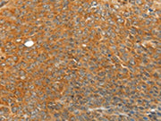 The image on the left is immunohistochemistry of paraffin-embedded Human ovarian cancer tissue using CSB-PA173569(TRIM21 Antibody) at dilution 1/20, on the right is treated with fusion protein. (Original magnification: ×200)